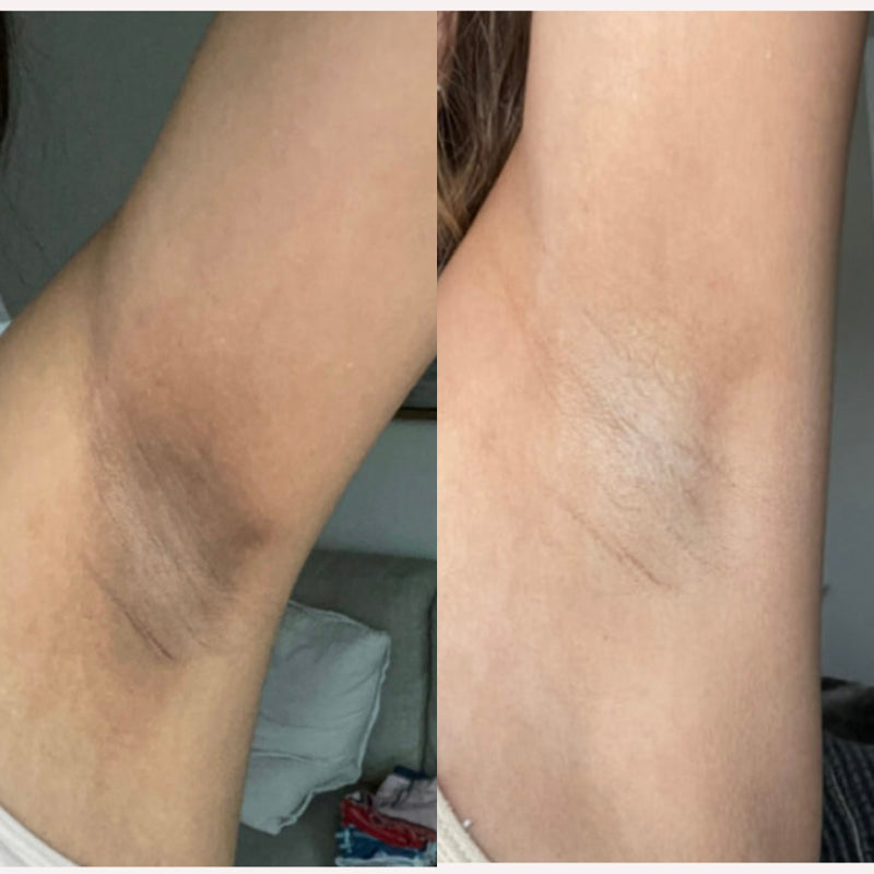 Antes y después de axila tras 4 semanas de uso de SkinUp Pro: piel más clara y sin vello