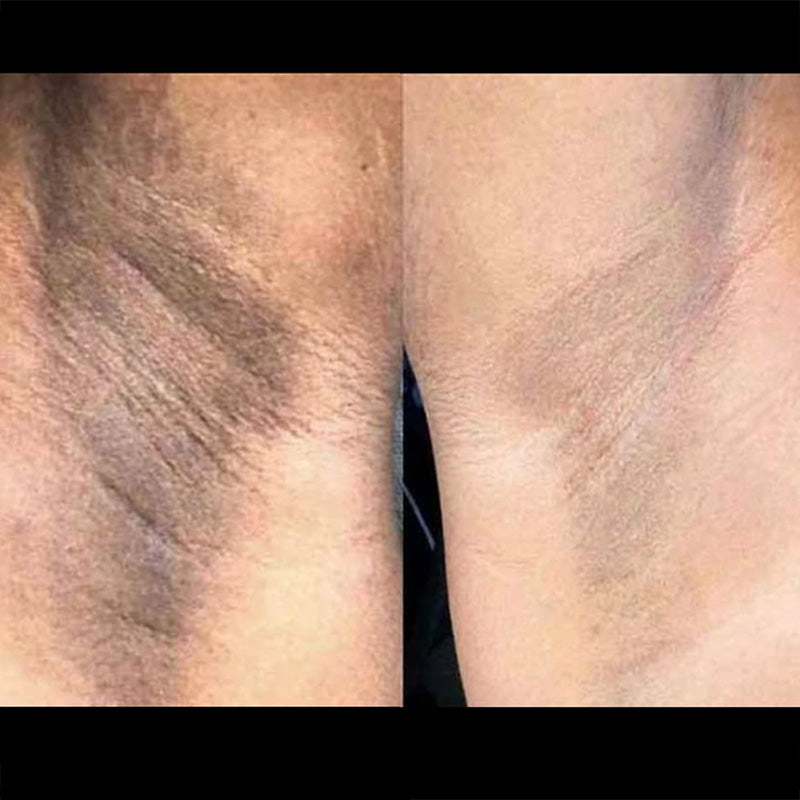 Antes y después de axila tras 4 semanas de uso de SkinUp Pro: piel más clara y sin vello