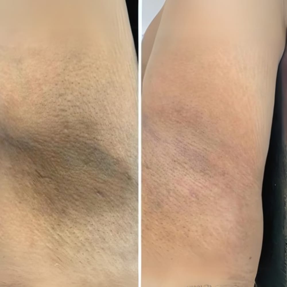 Antes y después de axila tras 4 semanas de uso de SkinUp Pro: piel más clara y sin vello